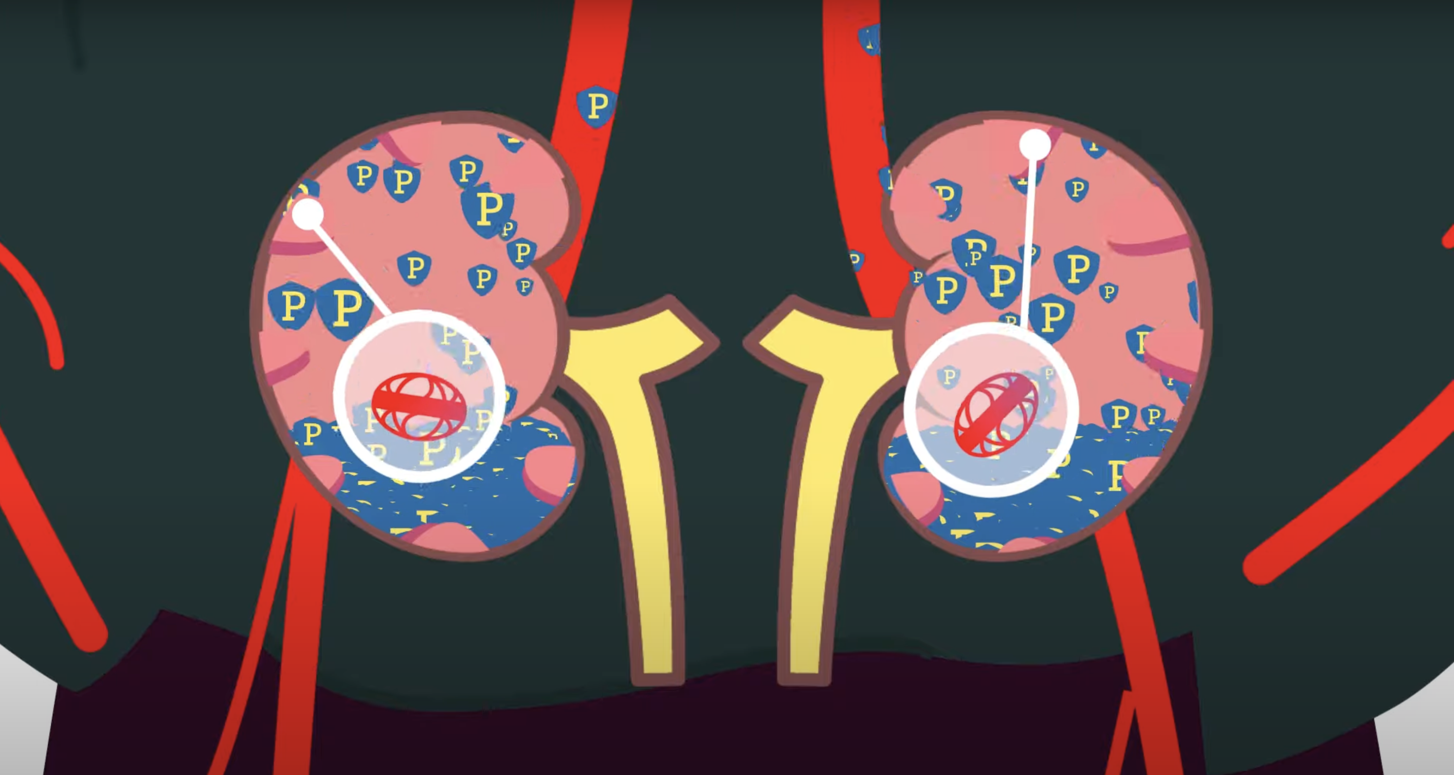 TITAN Health Awards Winner - Rare Diseases: Diagnosis and Treatment of C3G and IG-MPGN 1