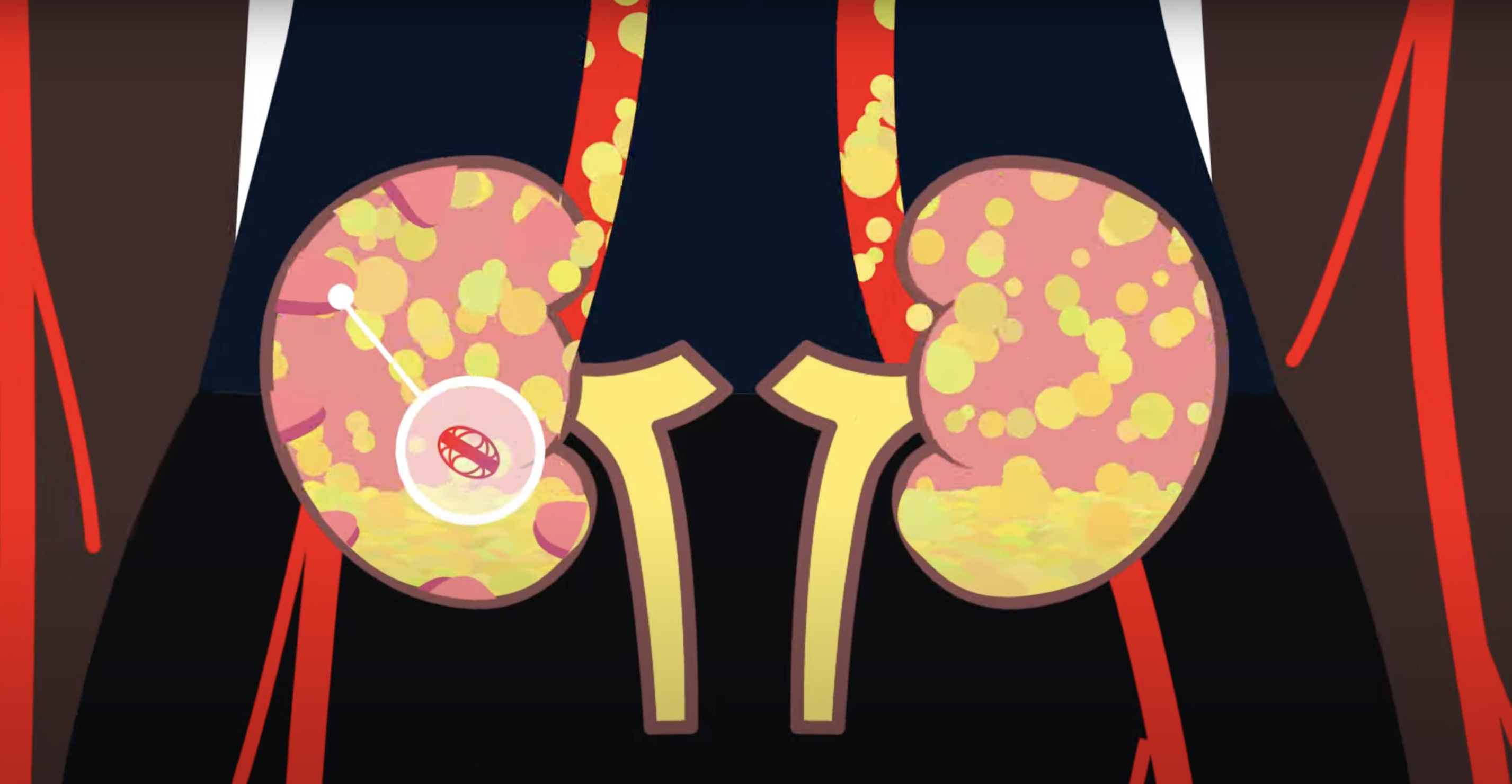 TITAN Health Awards Winner - Rare Diseases: Diagnosis and Treatment of C3G and IG-MPGN 2