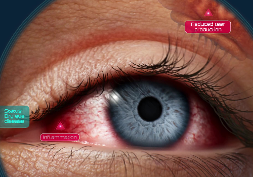 Dry Eye Disease & TL-925 MOA, Healthcare Awards Winner